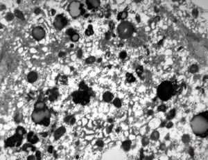 F,6y. | Wilson disease F,6y. | Wilson disease
